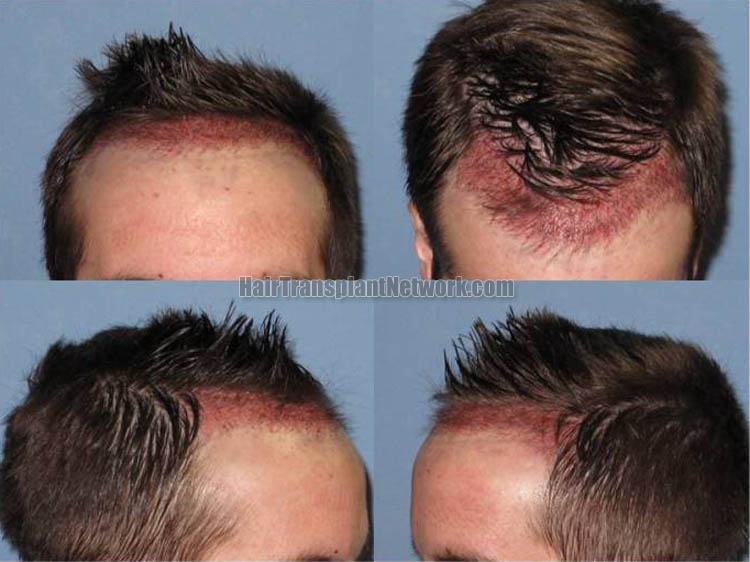 regrow hair on hairline